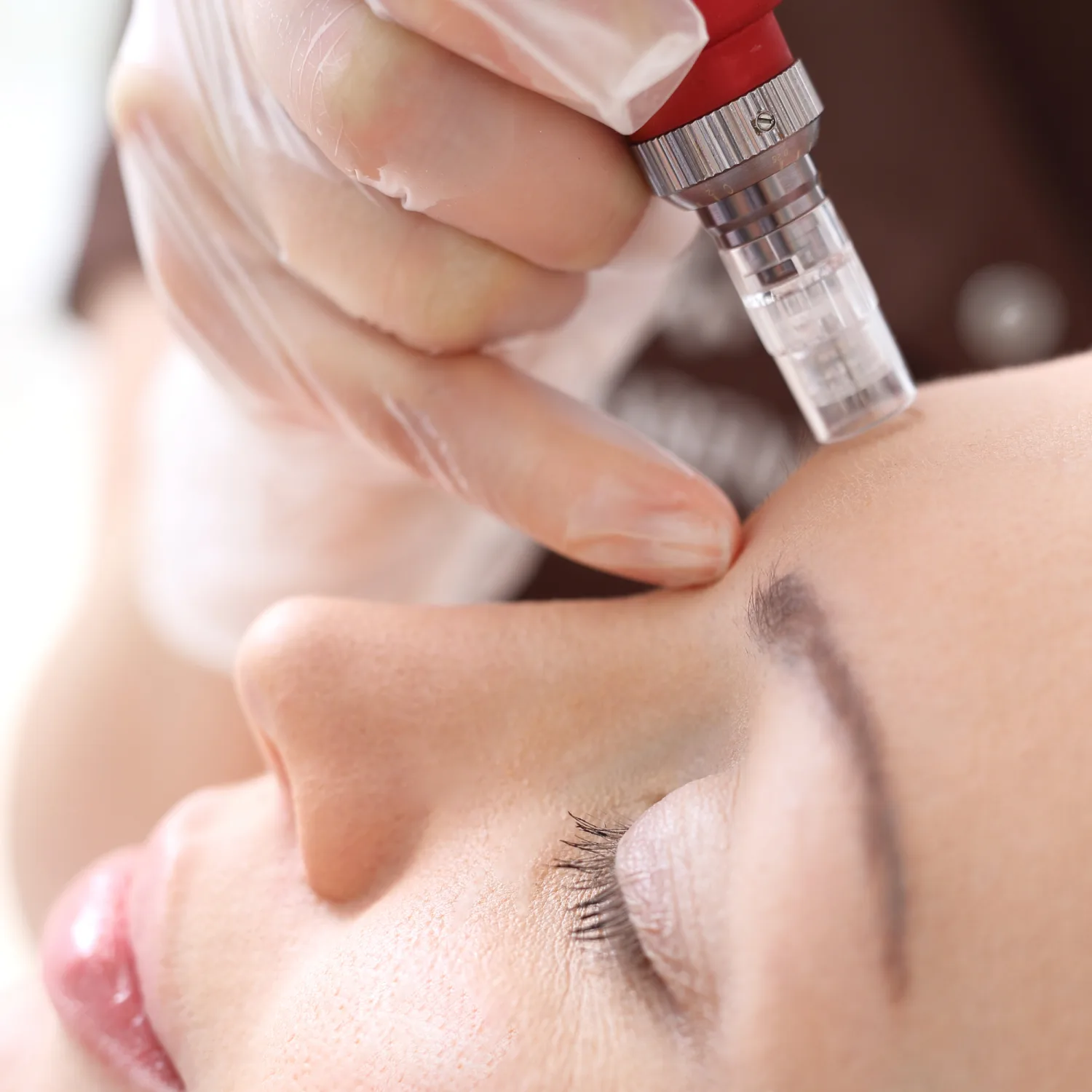 Micro Needling